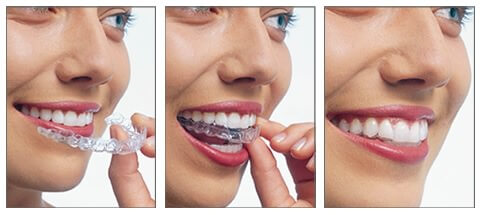 Invisalign Teen est un traitement en orthodontie pour adolescent